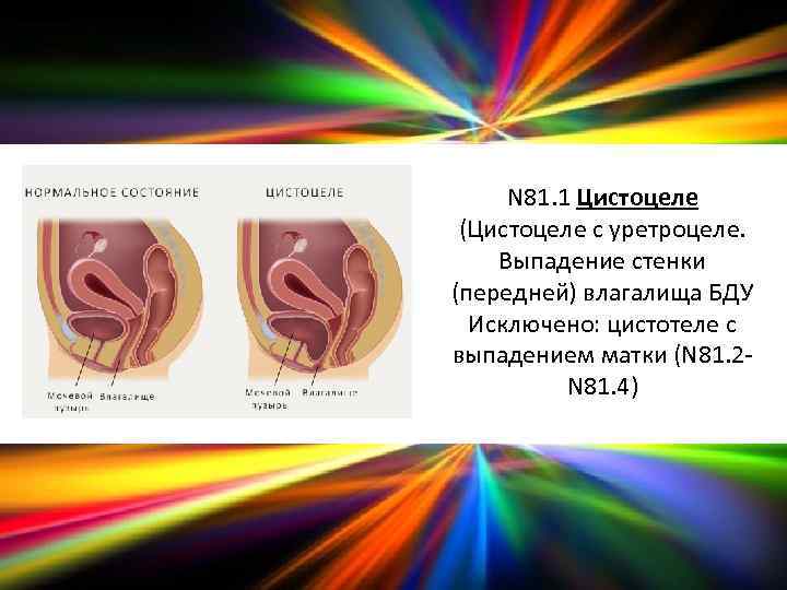 N 81. 1 Цистоцеле (Цистоцеле с уретроцеле. Выпадение стенки (передней) влагалища БДУ Исключено: цистотеле