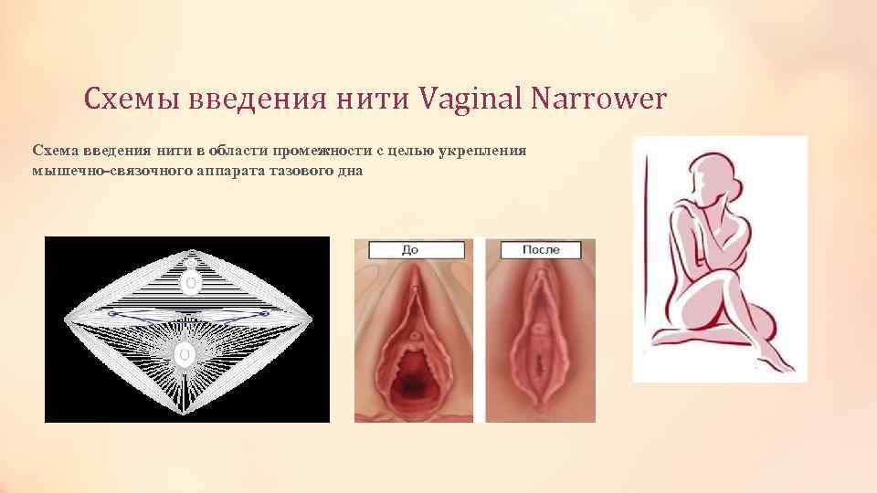 Схемы введения нити Vaginal Narrower Схема введения нити в области промежности с целью укрепления