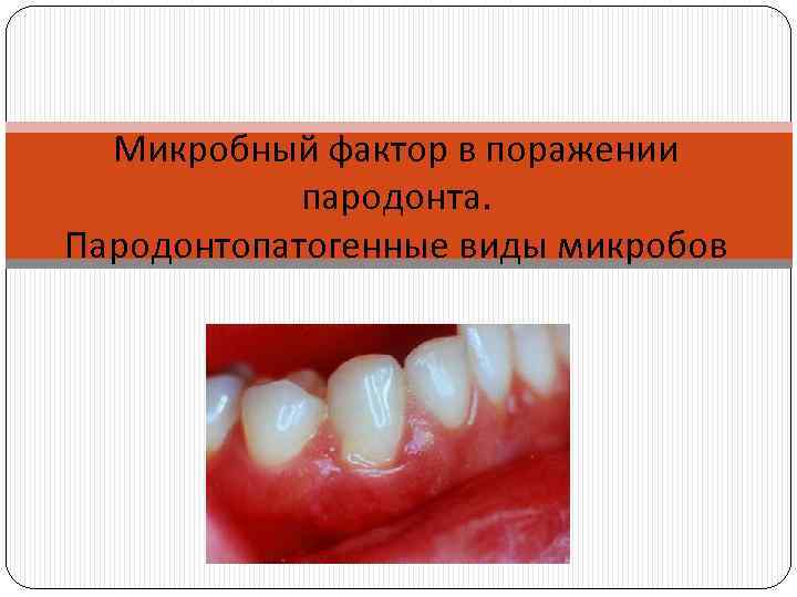 Микробный фактор в поражении пародонта. Пародонтопатогенные виды микробов 