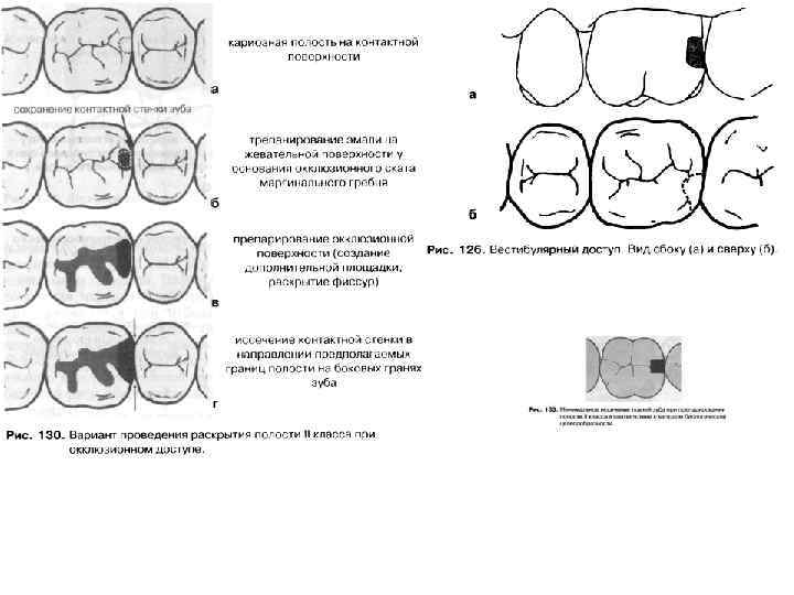 Препарирование кариозных полостей ii класса. Классификация кариозных полостей по Блэку. Классификация по локализации кариозной полости. Классификация кариеса по локализации по Блэку. Классификация кариозных полостей по Black.