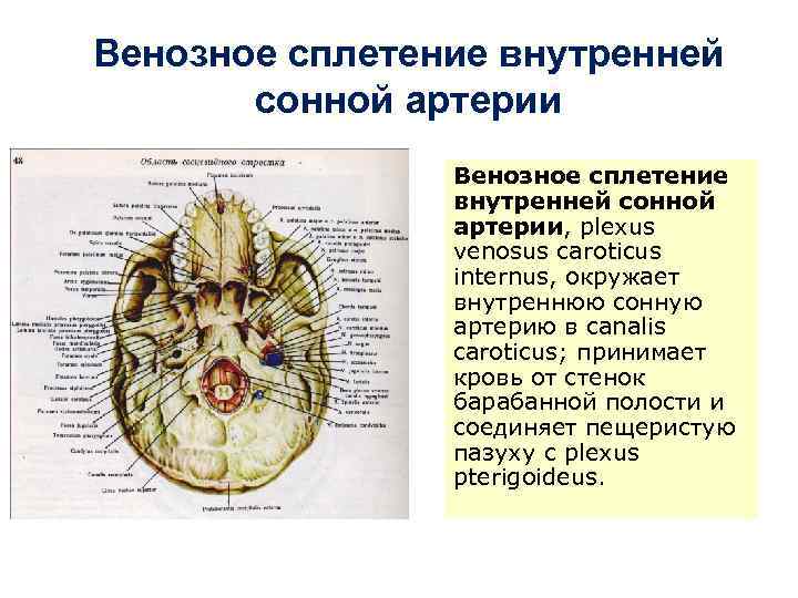 Венозное сплетение внутренней сонной артерии, plexus venosus caroticus internus, окружает внутреннюю сонную артерию в