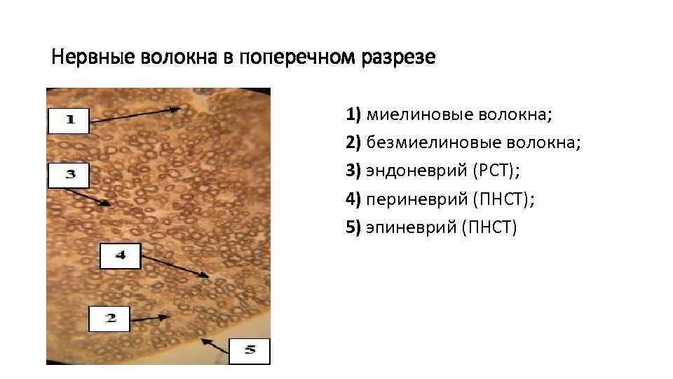 Нервные волокна в поперечном разрезе 1) миелиновые волокна; 2) безмиелиновые волокна; 3) эндоневрий (РСТ);