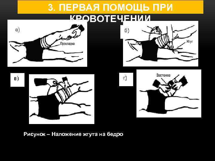 Наложение жгута на бедро. Оказание первой помощи при кровотечениях охрана труда. Охрана труда остановка кровотечения. Первая помощь при кровотечении охрана труда. Наложения жгута по охране труда.