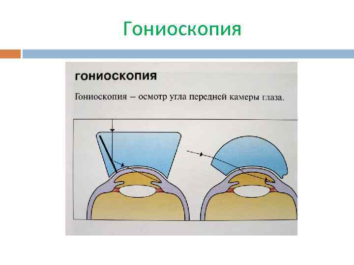 Гониоскопия 