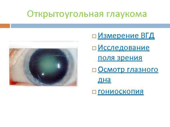 Открытоугольная глаукома Измерение ВГД Исследование поля зрения Осмотр глазного дна гониоскопия 