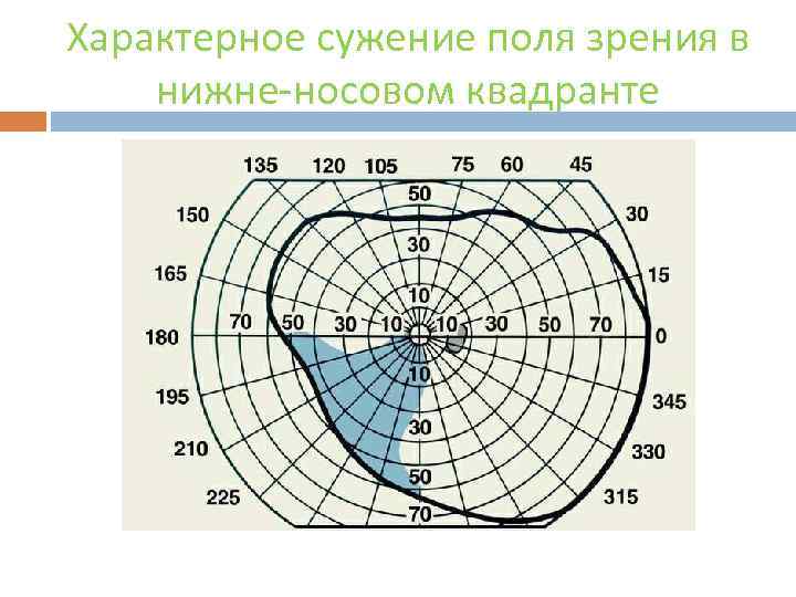 Характерное сужение поля зрения в нижне-носовом квадранте 