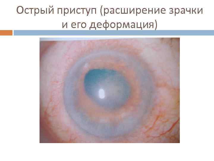 Острый приступ (расширение зрачки и его деформация) 