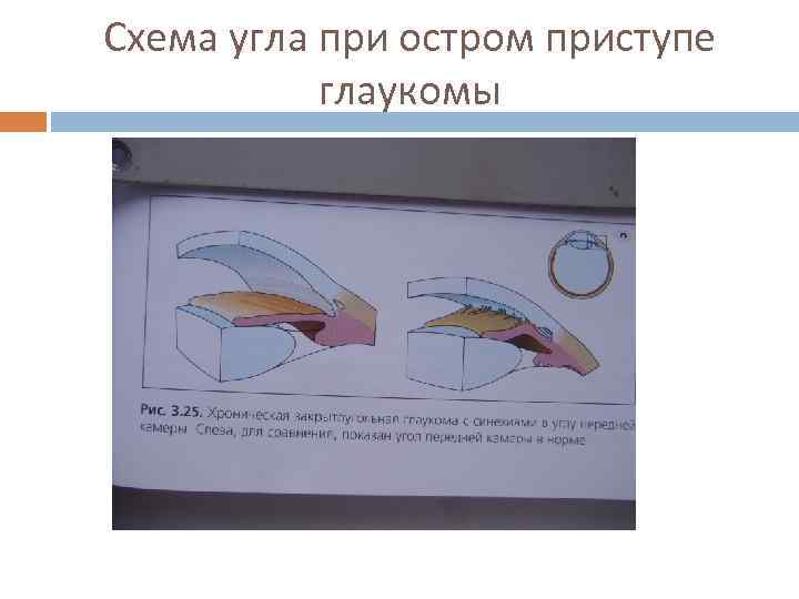 Схема угла при остром приступе глаукомы 