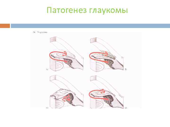 Патогенез глаукомы 