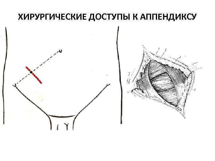 ХИРУРГИЧЕСКИЕ ДОСТУПЫ К АППЕНДИКСУ 