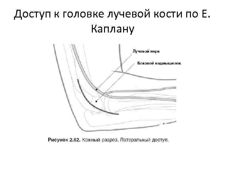 Доступ к головке лучевой кости по Е. Каплану 