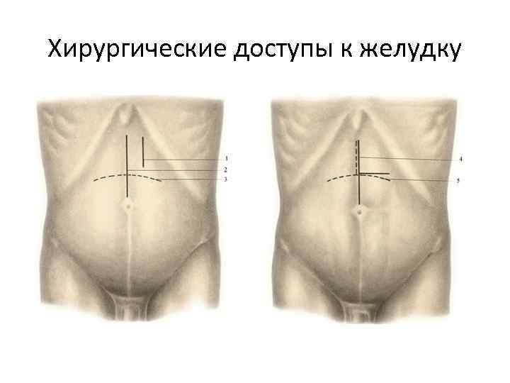 Хирургические доступы к желудку 