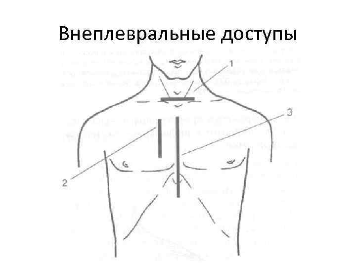 Внеплевральные доступы 