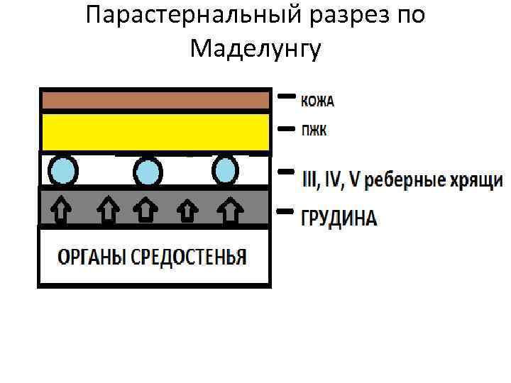 Парастернальный разрез по Маделунгу 