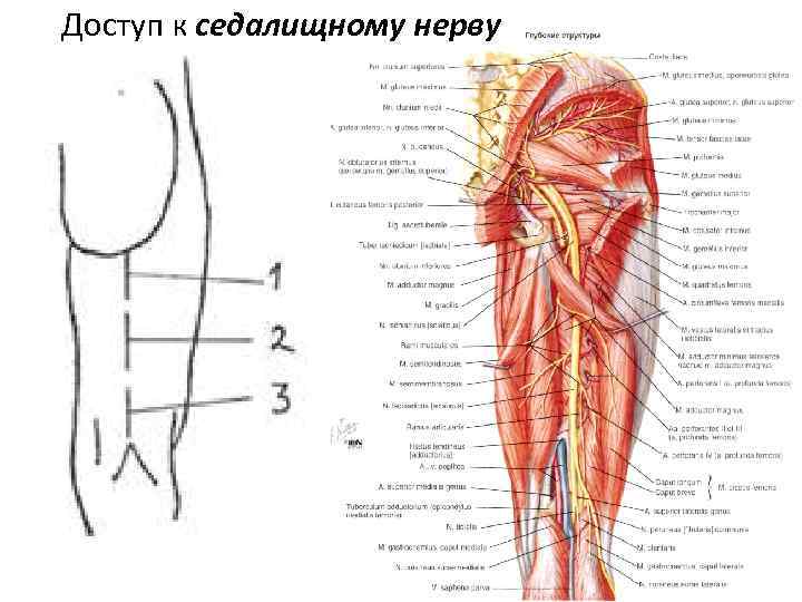 Доступ к седалищному нерву 