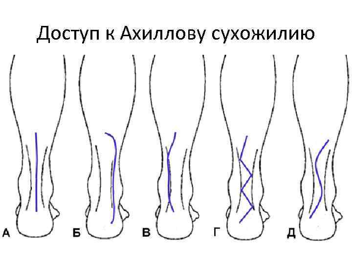 Доступ к Ахиллову сухожилию 