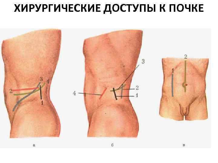 ХИРУРГИЧЕСКИЕ ДОСТУПЫ К ПОЧКЕ 