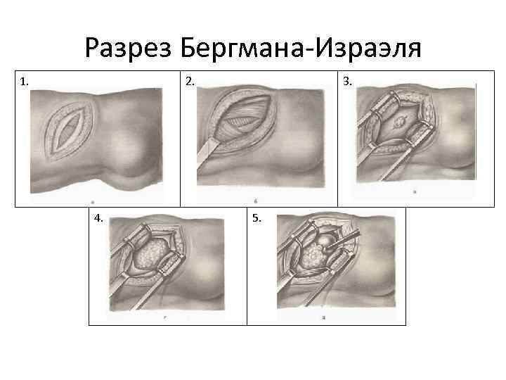 Разрез Бергмана-Израэля 1. 2. 4. 3. 5. 