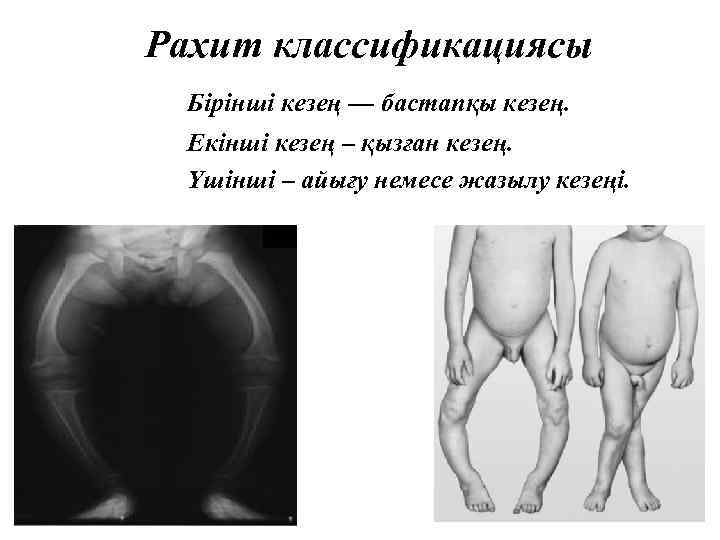  Рахит классификациясы Бірінші кезең — бастапқы кезең. Екінші кезең – қызған кезең. Үшінші