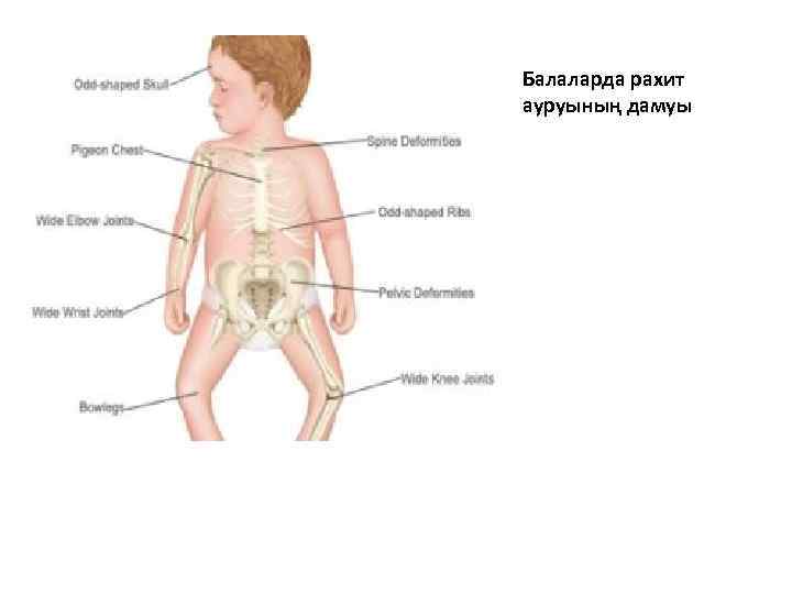 Презентация по педиатрии рахит