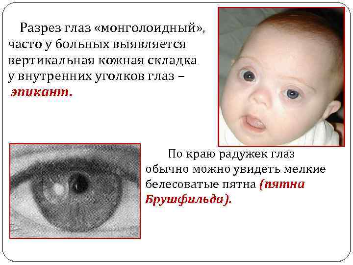 Разрез глаз «монголоидный» , часто у больных выявляется вертикальная кожная складка у внутренних уголков