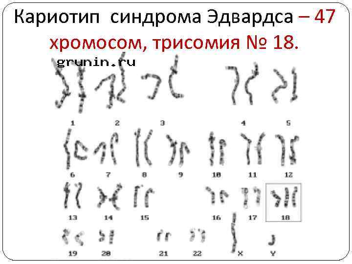 Кариотип синдрома Эдвардса – 47 хромосом, трисомия № 18. 