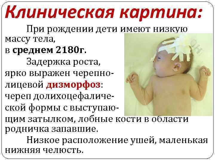 Клиническая картина: При рождении дети имеют низкую массу тела, в среднем 2180 г. Задержка