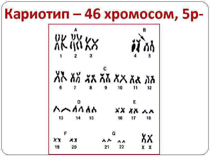 Кариотип – 46 хромосом, 5 р- 