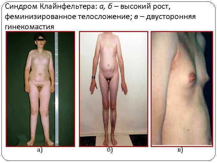 Синдром Клайнфельтера: а, б – высокий рост, феминизированное телосложение; в – двусторонняя гинекомастия а)