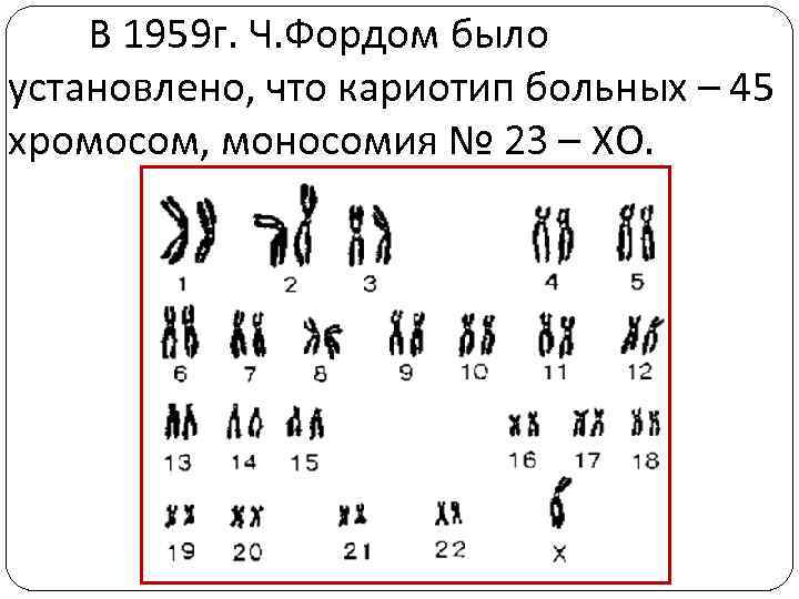 В 1959 г. Ч. Фордом было установлено, что кариотип больных – 45 хромосом, моносомия