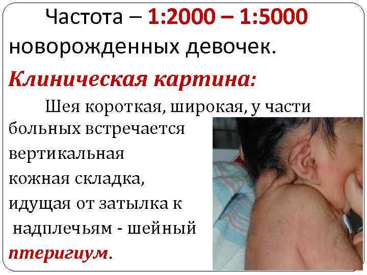Частота – 1: 2000 – 1: 5000 новорожденных девочек. Клиническая картина: Шея короткая, широкая,