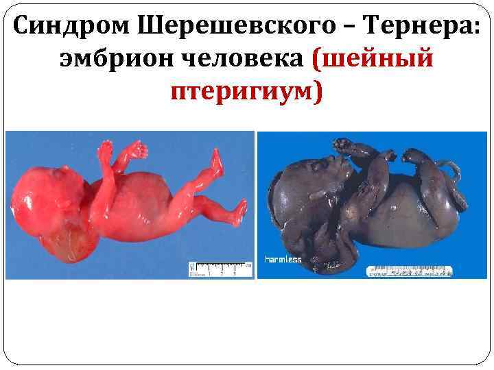 Синдром Шерешевского – Тернера: эмбрион человека (шейный птеригиум) 