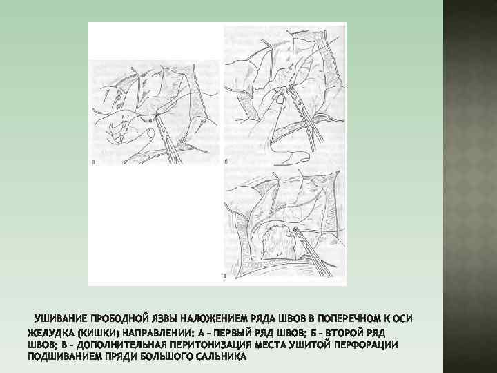 УШИВАНИЕ ПРОБОДНОЙ ЯЗВЫ НАЛОЖЕНИЕМ РЯДА ШВОВ В ПОПЕРЕЧНОМ К ОСИ ЖЕЛУДКА (КИШКИ) НАПРАВЛЕНИИ: А