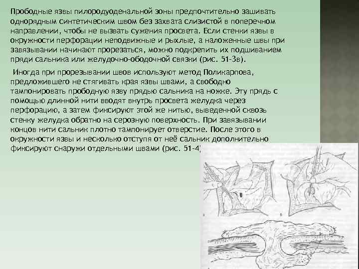 Прободные язвы пилородуоденальной зоны предпочтительно зашивать однорядным синтетическим швом без захвата слизистой в поперечном