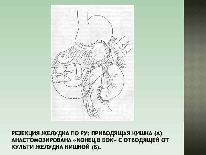РЕЗЕКЦИЯ ЖЕЛУДКА ПО РУ: ПРИВОДЯЩАЯ КИШКА (А) АНАСТОМОЗИРОВАНА «КОНЕЦ В БОК» С ОТВОДЯЩЕЙ ОТ