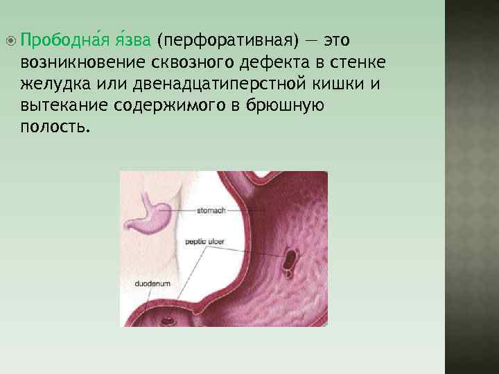 Пенетрация язвы лечение. Язвенная болезнь желудка прободение. Перфоративная язва эндоскопия. Перфоративная язва желудка симптомы. Прободение язвы желудка симптомы.