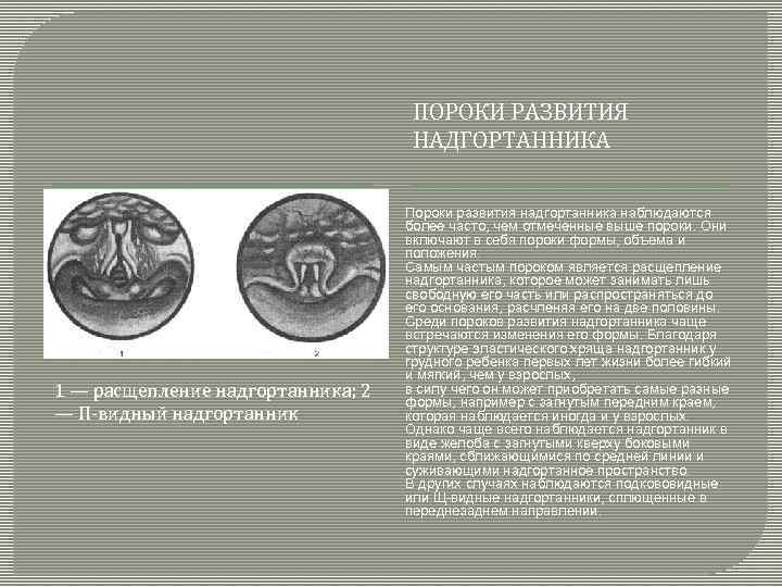 ПОРОКИ РАЗВИТИЯ НАДГОРТАННИКА 1 — расщепление надгортанника; 2 — П-видный надгортанник Пороки развития надгортанника