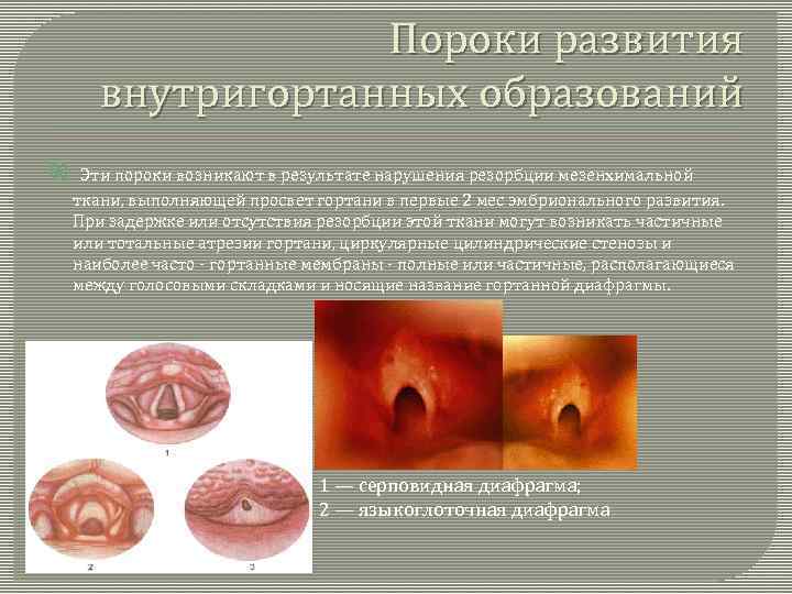 Пороки развития внутригортанных образований Эти пороки возникают в результате нарушения резорбции мезенхимальной ткани, выполняющей