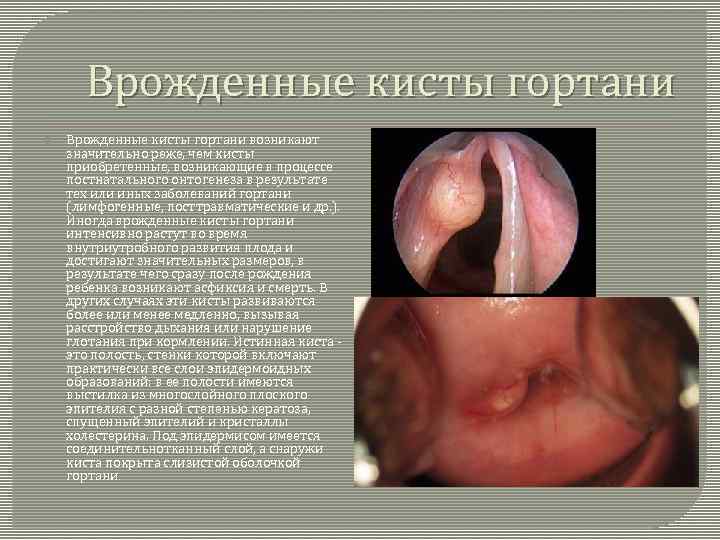 Врожденные кисты гортани возникают значительно реже, чем кисты приобретенные, возникающие в процессе постнатального онтогенеза