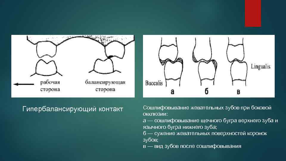 Гипербалансирующий контакт Сошлифовывание жевательных зубов при боковой окклюзии: а — сошлифовывание щечного бугра верхнего