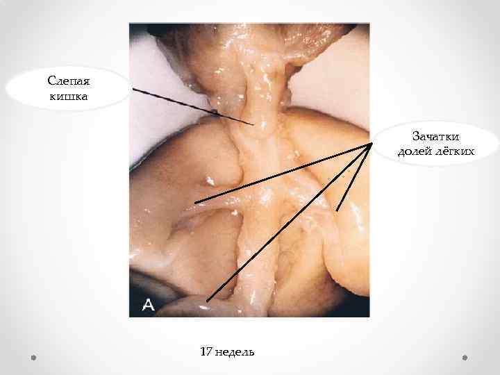 Слепая кишка Зачатки долей лёгких 17 недель 