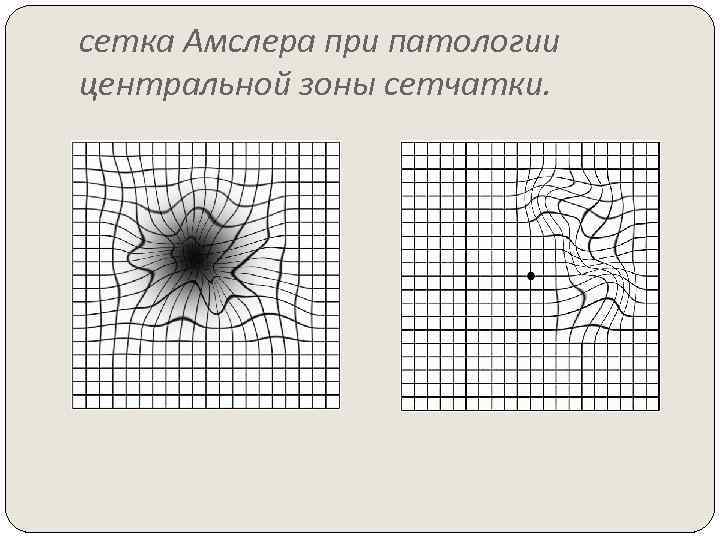 сетка Амслера при патологии центральной зоны сетчатки. 