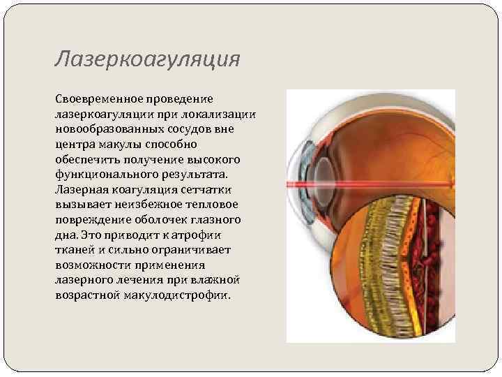 Лазеркоагуляция Своевременное проведение лазеркоагуляции при локализации новообразованных сосудов вне центра макулы способно обеспечить получение