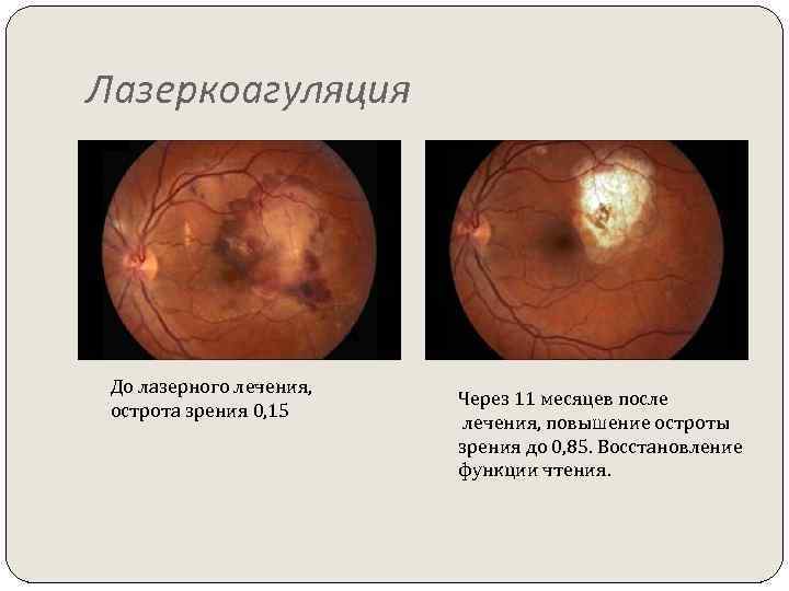 Лазеркоагуляция До лазерного лечения, острота зрения 0, 15 Через 11 месяцев после лечения, повышение