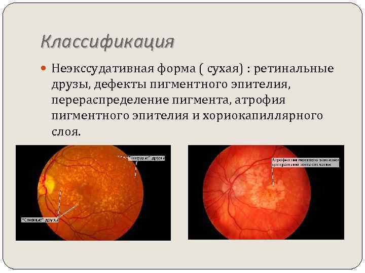 Классификация Неэкссудативная форма ( сухая) : ретинальные друзы, дефекты пигментного эпителия, перераспределение пигмента, атрофия