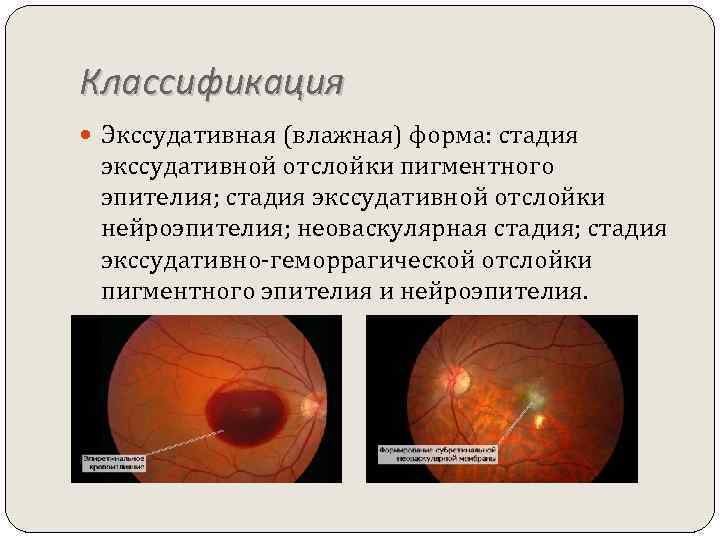 Классификация Экссудативная (влажная) форма: стадия экссудативной отслойки пигментного эпителия; стадия экссудативной отслойки нейроэпителия; неоваскулярная