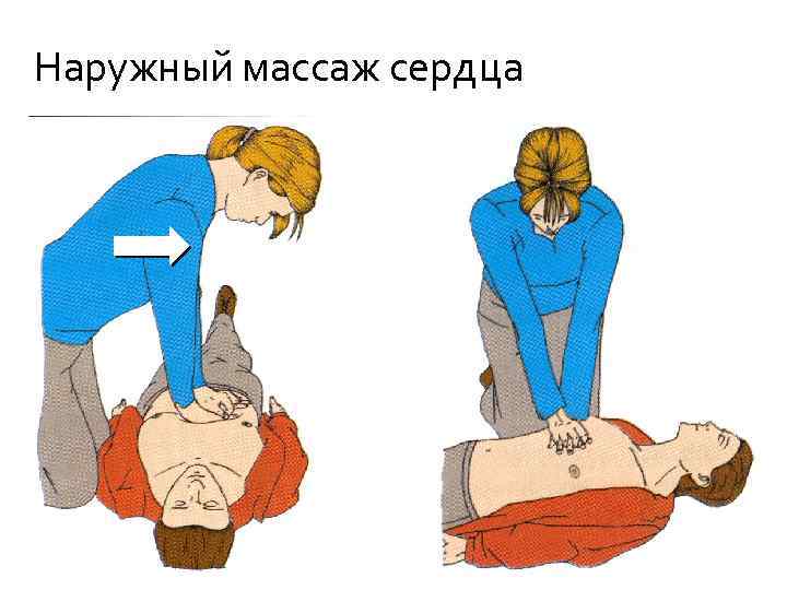 Наружный массаж сердца 
