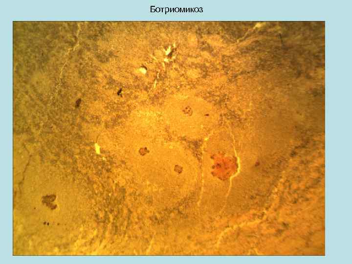 Ботриомикоз 