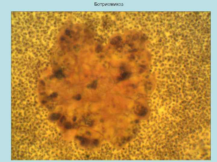 Ботриомикоз 