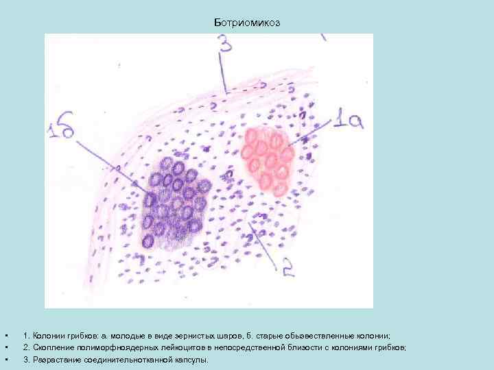 Ботриомикоз • • • 1. Колонии грибков: а. молодые в виде зернистых шаров, б.